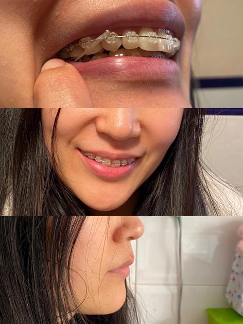 怀孕 牙齿正畸矫正-图1