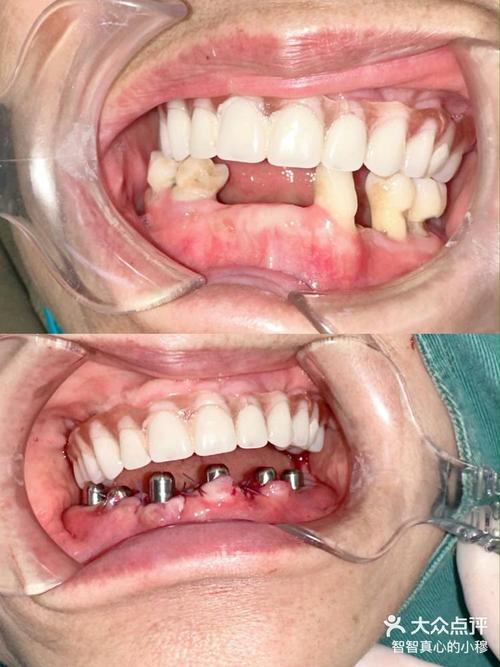 植骨种牙效果图-图1 植骨种牙效果图-图1