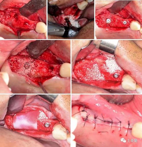 植骨种牙效果图-图2 植骨种牙效果图-图2