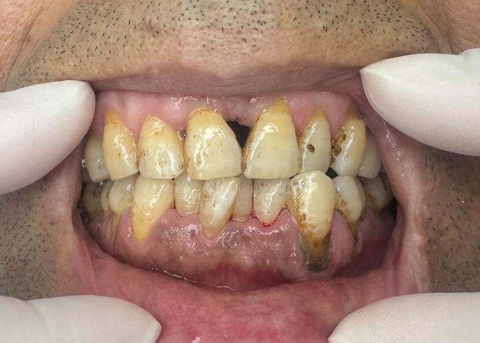 重度牙周炎患者能正畸吗？图片有何警示？-图1