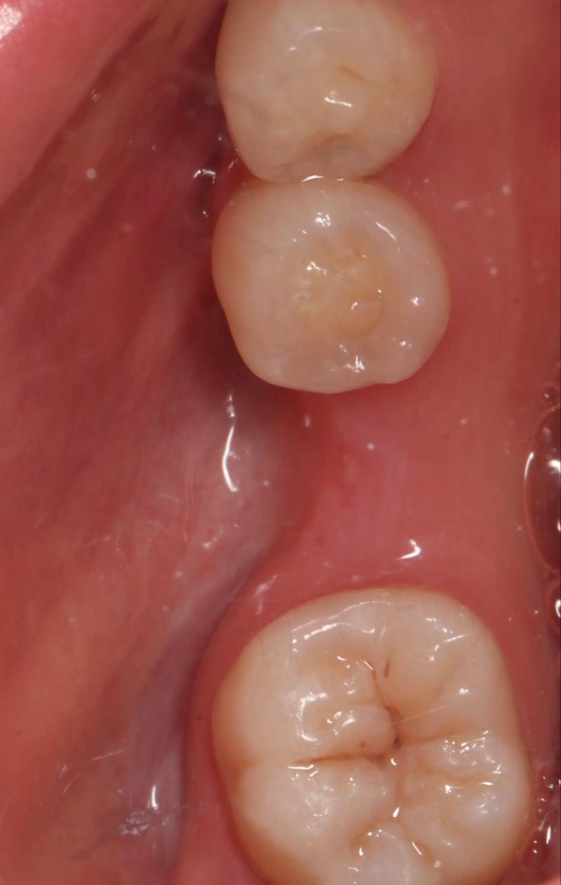 牙周植骨半年后-图2 牙周植骨半年后-图2