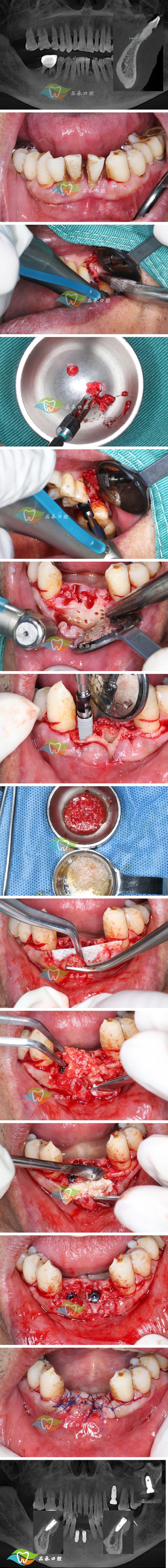 牙周植骨半年后-图1 牙周植骨半年后-图1