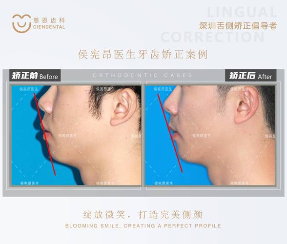 正畸Tweed是谁？正畸领域的关键技术揭秘-图1