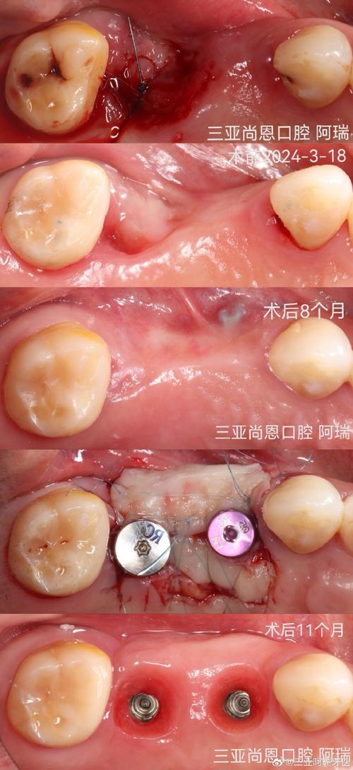 同福医植牙效果到底好不好？真实效果与体验如何？-图3