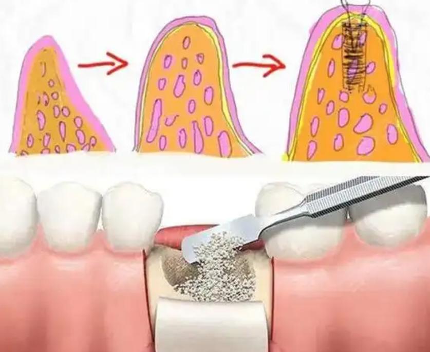 拔完牙需要植骨-图1