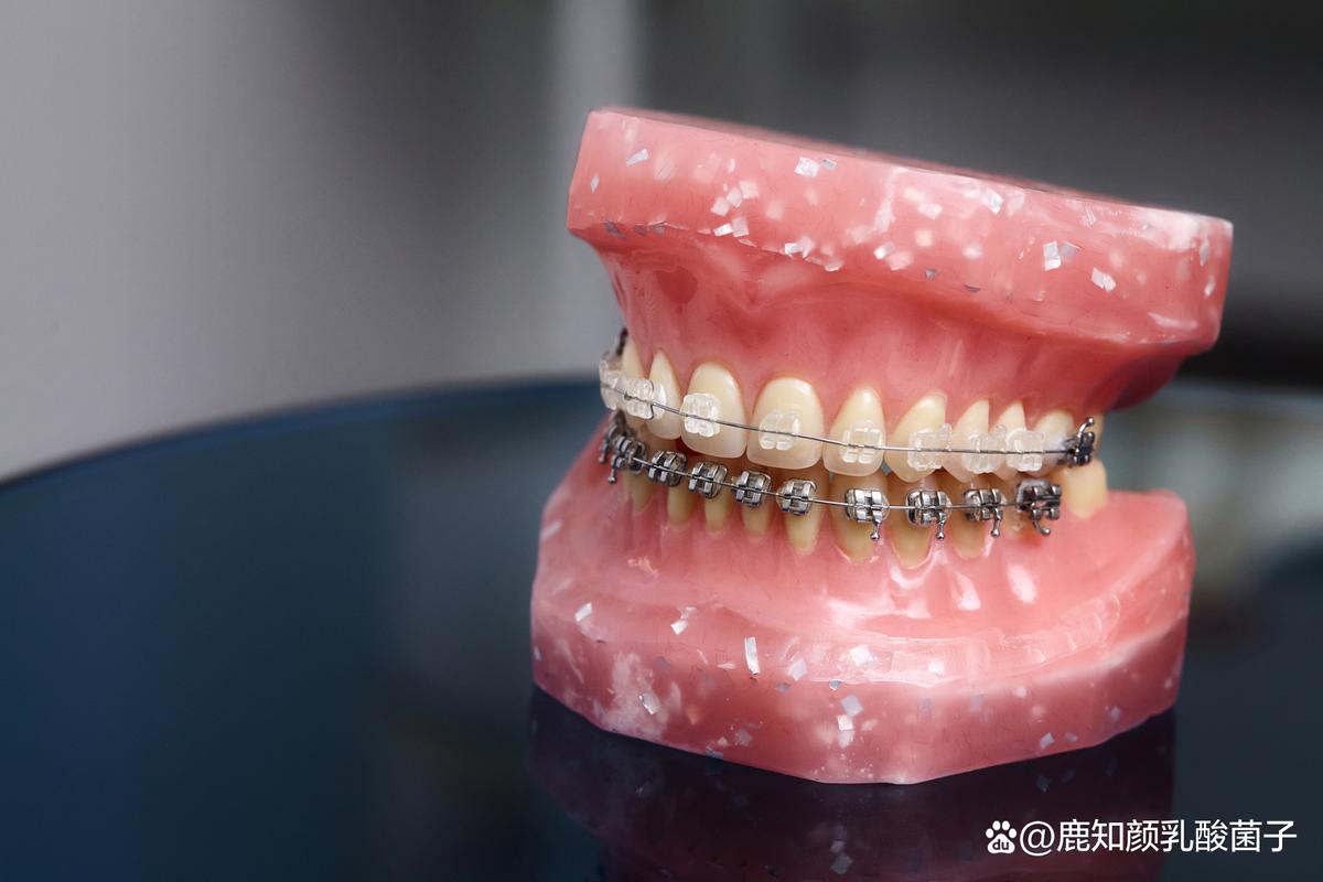 乌鲁木齐牙齿正畸效果如何？价格大概多少？适合哪些人？-图1