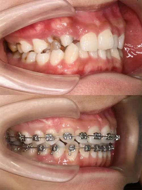 乌鲁木齐牙齿正畸效果如何？价格大概多少？适合哪些人？-图2