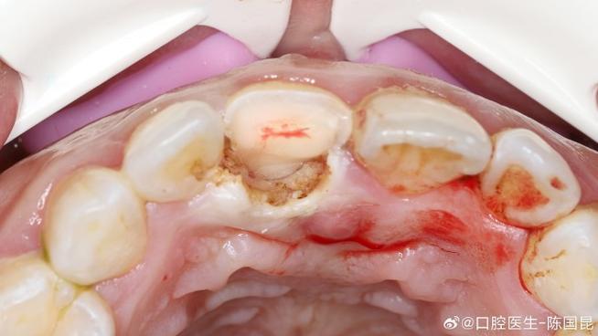 种牙植骨创伤面-图3