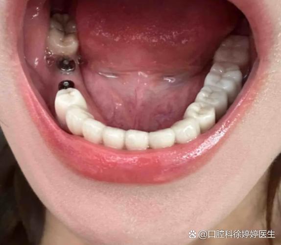 牙槽植骨后吃饭-图1