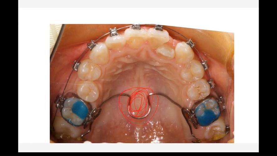 正畸Damon系统矫正效果如何？与传统矫正相比有何优势？-图2