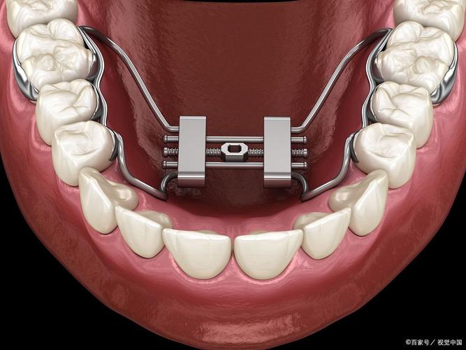 正畸Damon系统矫正效果如何?与传统矫正相比有何优势?-图3 正畸Damon系统矫正效果如何?与传统矫正相比有何优势?-图3