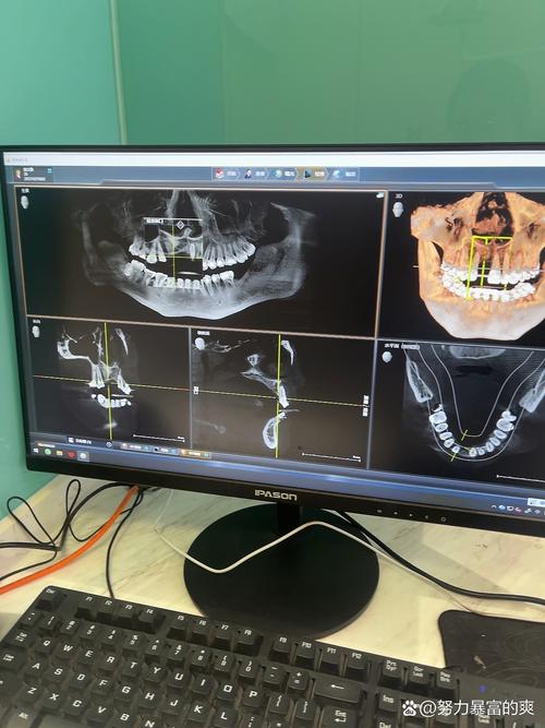 计算机导航植牙相比传统植牙，精准度和安全性优势何在？-图1