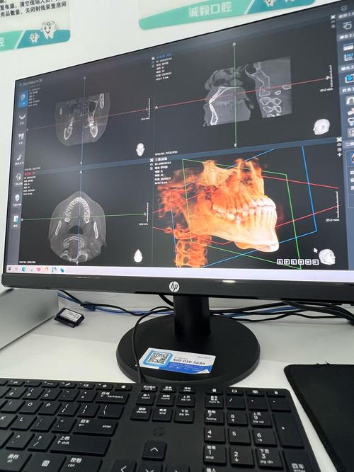 计算机导航植牙相比传统植牙，精准度和安全性优势何在？-图3