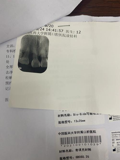 牙周翻瓣 植骨-图1