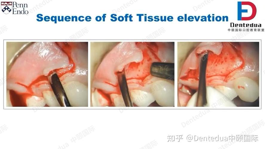 牙周翻瓣 植骨-图3