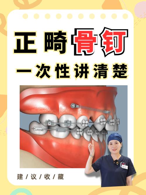 正畸牙钉多少钱一颗？价格差异大吗？影响因素有哪些？-图2