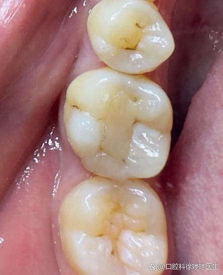 正畸力度过大牙髓炎-图2
