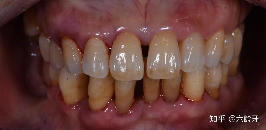 正畸力度过大牙髓炎-图1