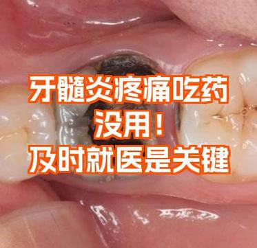 正畸力度过大牙髓炎-图3