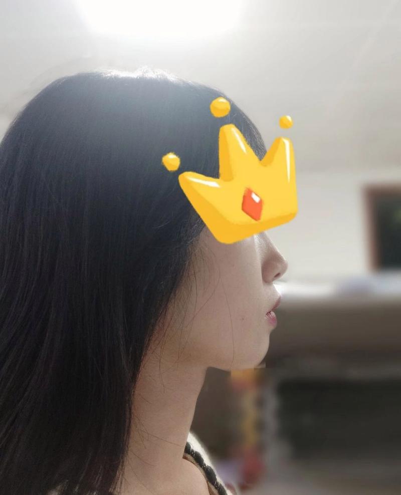 骨性二类错颌患者能通过正畸治疗改善吗？-图2