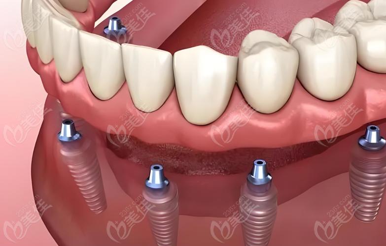 种植牙植体手术-图2 种植牙植体手术-图2