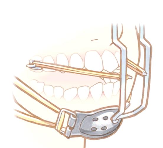 正畸一类牵引示意图-图1