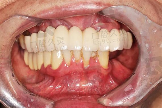 明星全口腔植牙-图1 明星全口腔植牙-图1