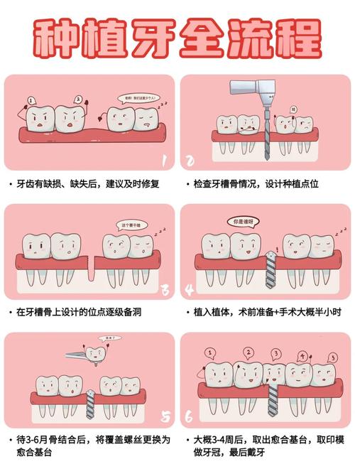 植牙分几个阶段-图1