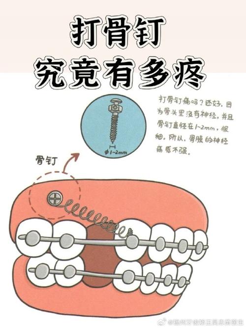 正畸骨钉什么时候需要上?医生如何确定最佳植入时机?-图3 正畸骨钉什么时候需要上?医生如何确定最佳植入时机?-图3