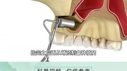 植牙外提升咳嗽-图1