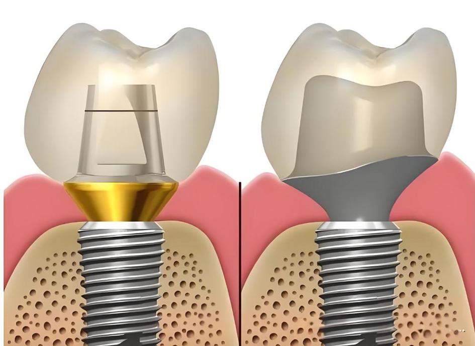 植牙外提升咳嗽-图2
