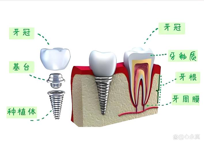 植牙系统哪种好？如何挑选适合自己的优质品牌？-图3