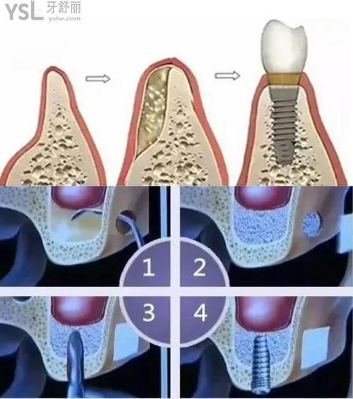 种植牙植骨运动-图3 种植牙植骨运动-图3