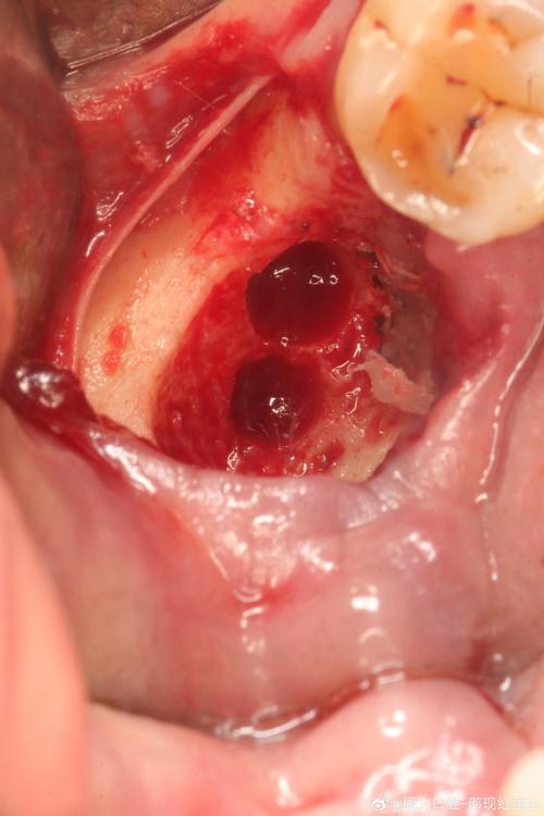 种植牙植骨肿痛-图2