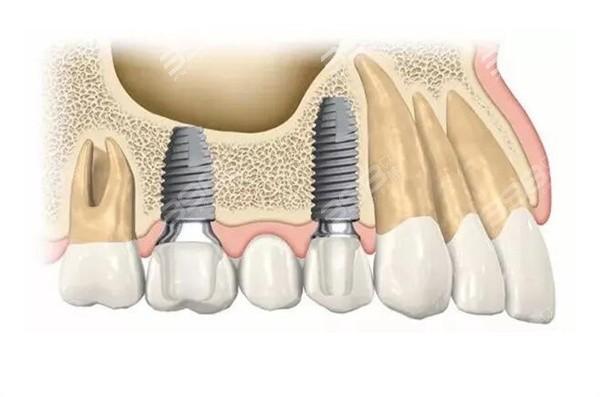 罗湖植牙哪里好？这么多机构怎么选才靠谱？-图2