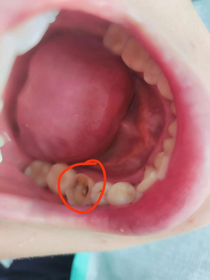 植牙后为何看不见牙根?是正常情况还是存在问题?需要处理吗?-图2 植牙后为何看不见牙根?是正常情况还是存在问题?需要处理吗?-图2