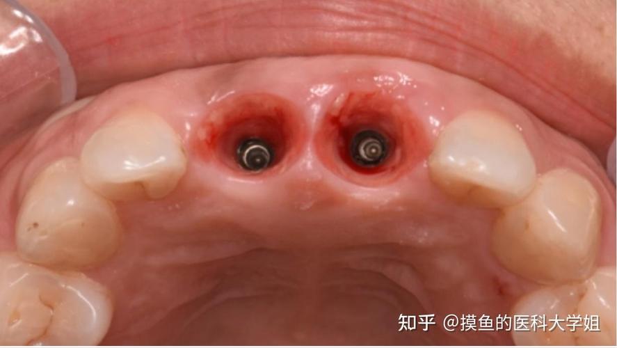 种植牙做好后,效果能维持多久?需注意哪些问题?-图1 种植牙做好后,效果能维持多久?需注意哪些问题?-图1