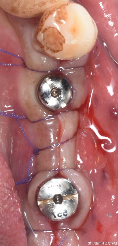 种植牙做好后,效果能维持多久?需注意哪些问题?-图3 种植牙做好后,效果能维持多久?需注意哪些问题?-图3