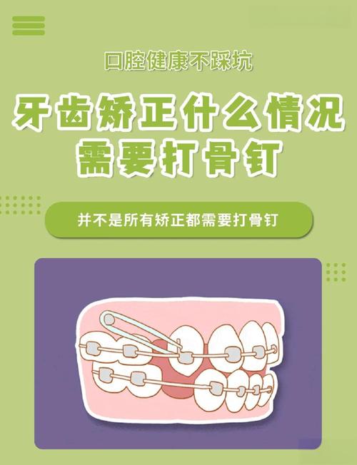 正畸不打骨钉可以吗-图1 正畸不打骨钉可以吗-图1