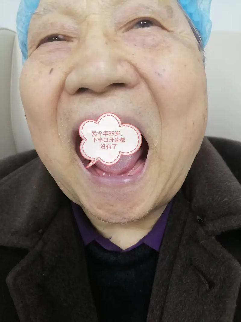 老人植牙会掉吗-图3
