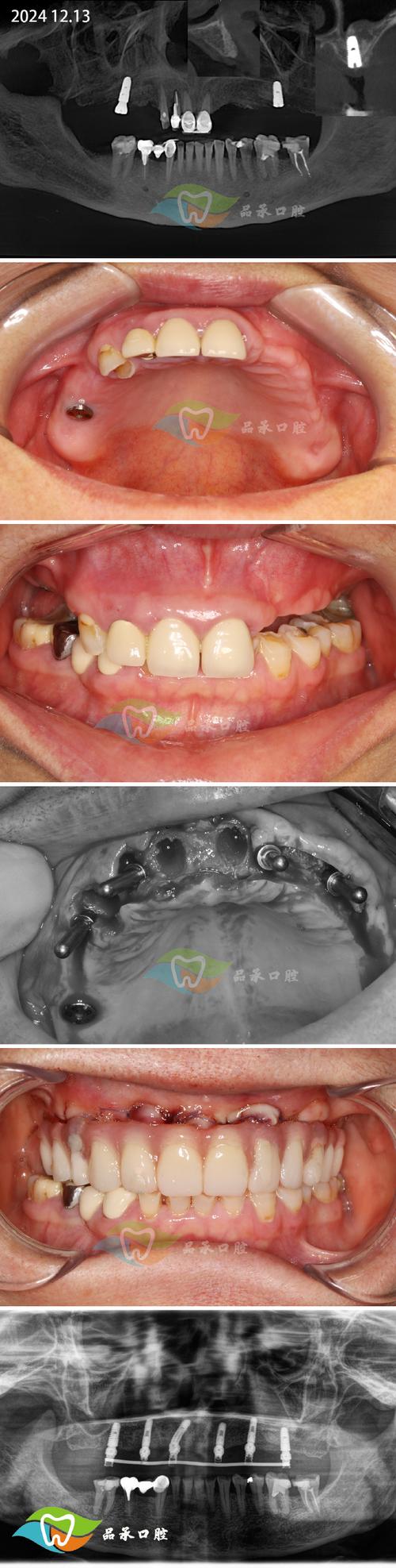 口腔骨移植植牙-图3