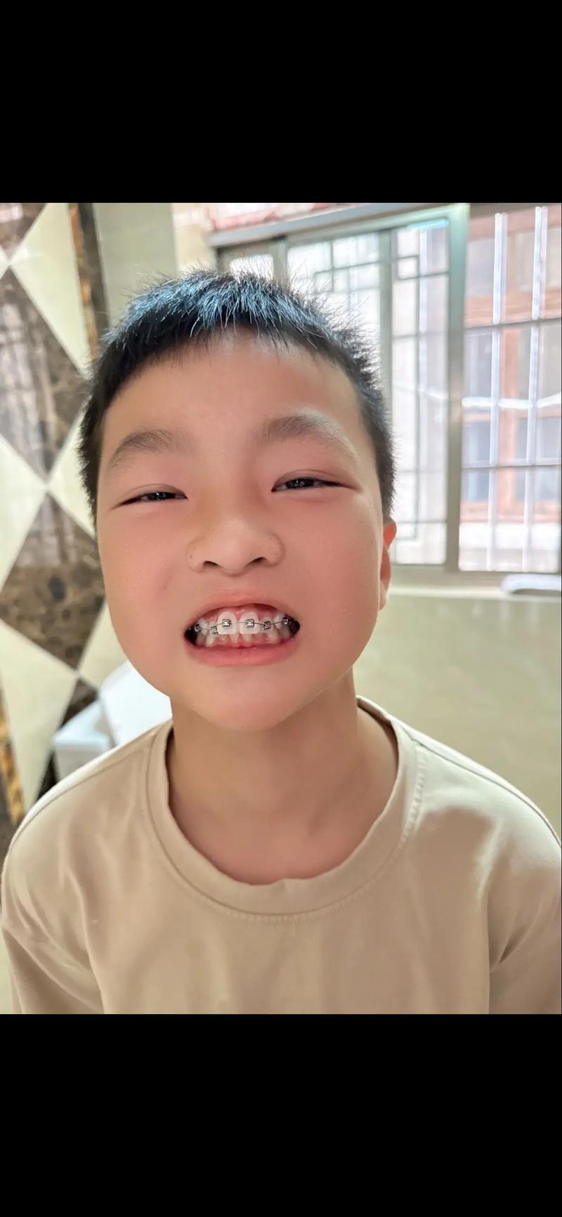 正畸下排牙齿太往里怎么办？-图1