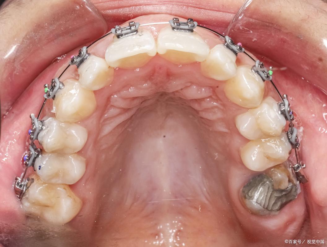 正畸下排牙齿太往里怎么办？-图2