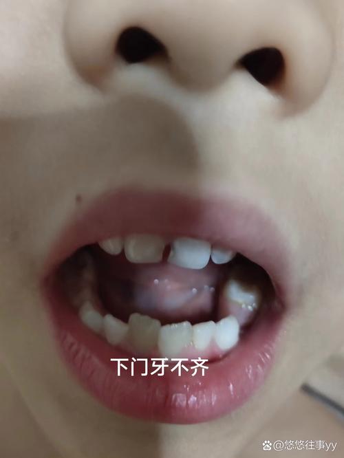 儿童正畸牙齿后，会有哪些后遗症？-图1