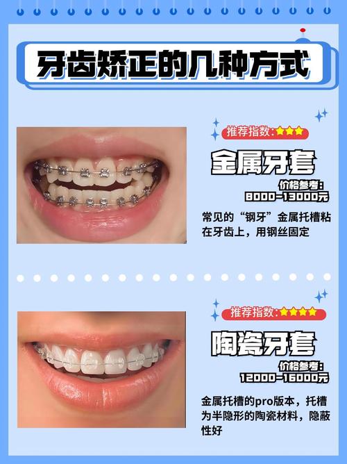 儿童正畸牙套有哪些种类？哪种更适合孩子？-图2