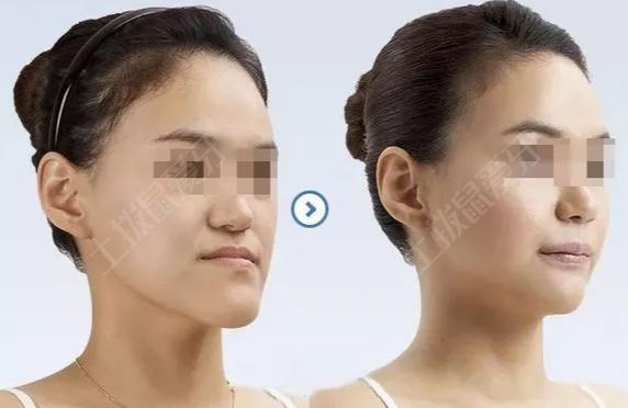 地包天正畸前后照片对比，效果真的明显吗？-图2