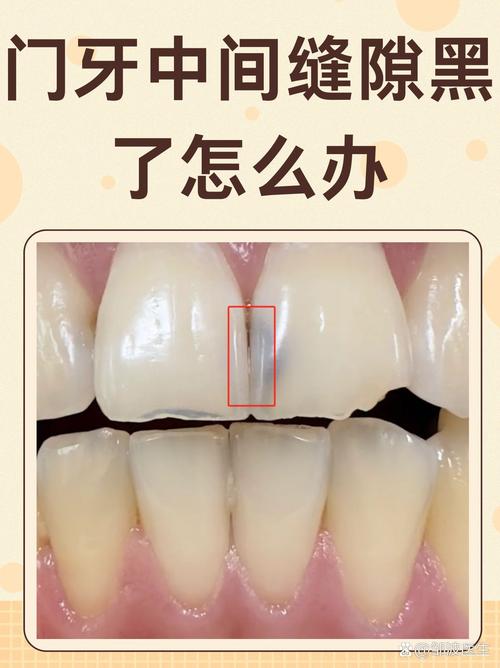 正畸后牙齿有缝隙吗-图2