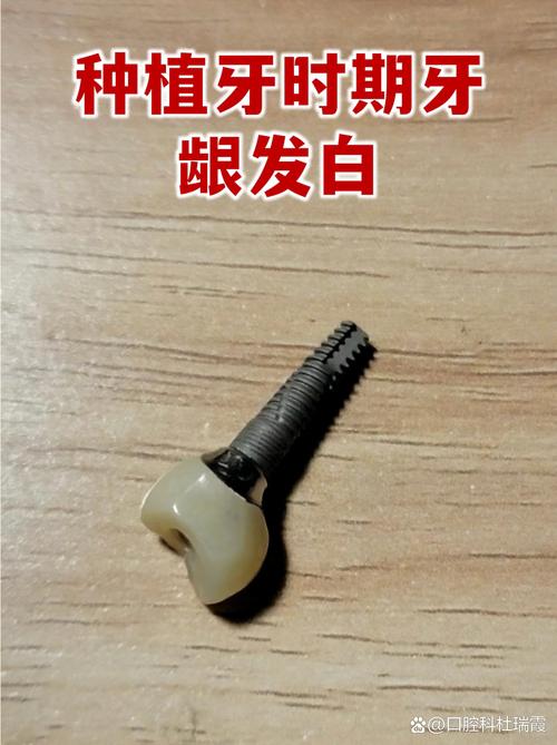 植牙后多久能彻底愈合？愈合周期一般需要多久？-图3