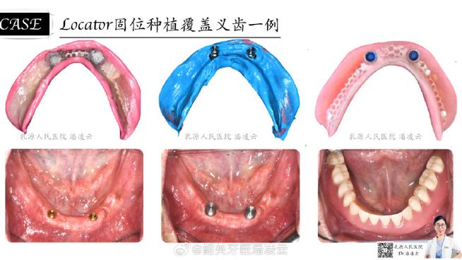 bego植牙图-图3 bego植牙图-图3