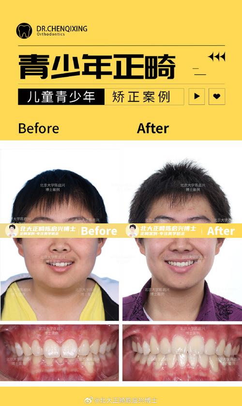 深覆合正畸前后对比-图2